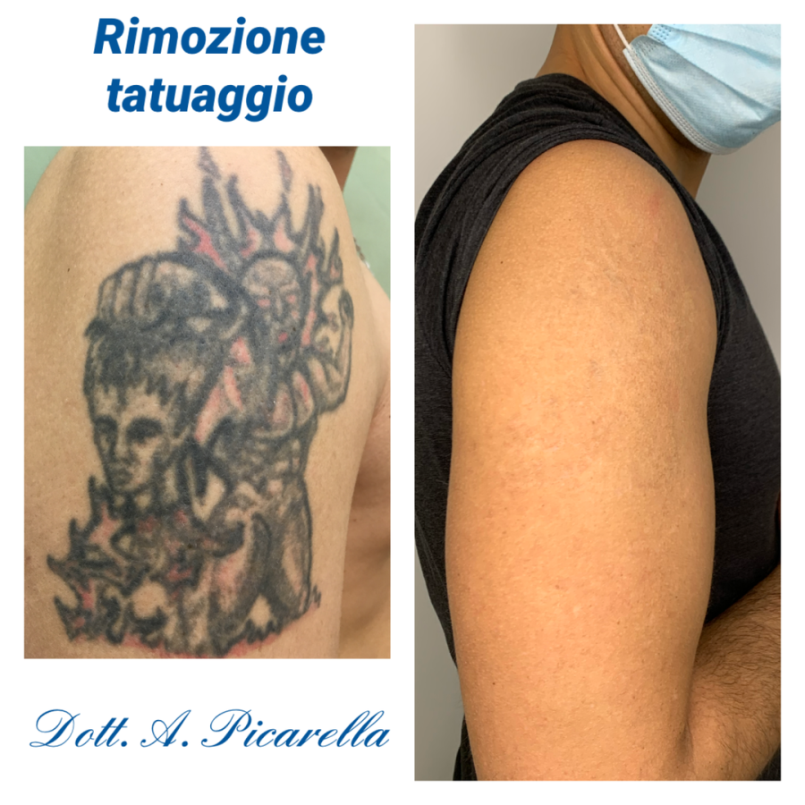 Chirurgia Estetica Picarella Rimozione Tatuaggi